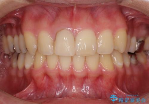 銀歯を白くしたい　セラミックによる審美歯科治療の症例 治療前
