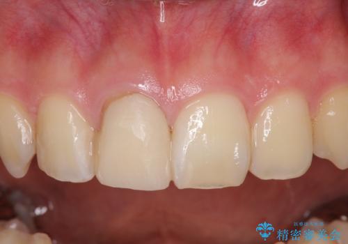 銀歯を白くしたい　セラミックによる審美歯科治療の治療前