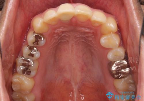 銀歯を白くしたい セラミックによる審美歯科治療の治療前