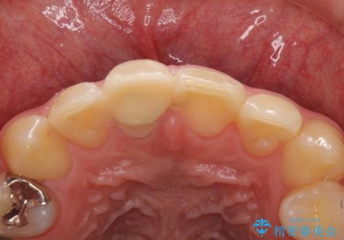 銀歯を白くしたい セラミックによる審美歯科治療の治療前