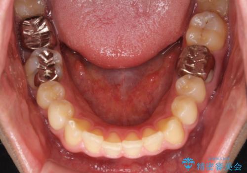 銀歯を白くしたい セラミックによる審美歯科治療の治療前