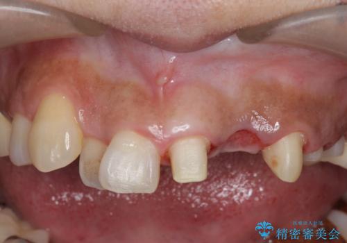 オールセラミッククラウン 根管治療のやり直しの治療中