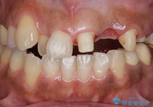 オールセラミッククラウン 根管治療のやり直しの治療中