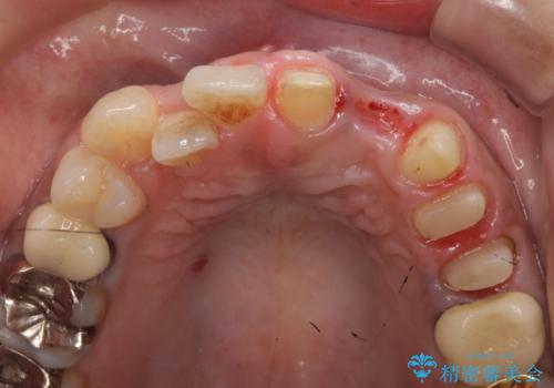 オールセラミッククラウン 根管治療のやり直しの治療中