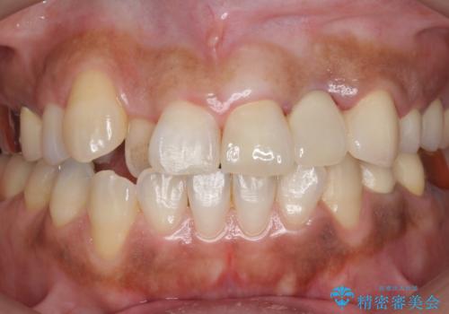 オールセラミッククラウン 根管治療のやり直しの治療後