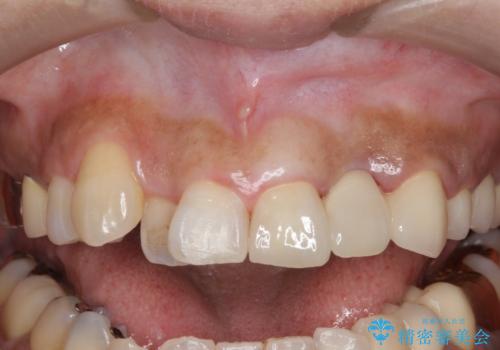 オールセラミッククラウン 根管治療のやり直しの症例 治療後