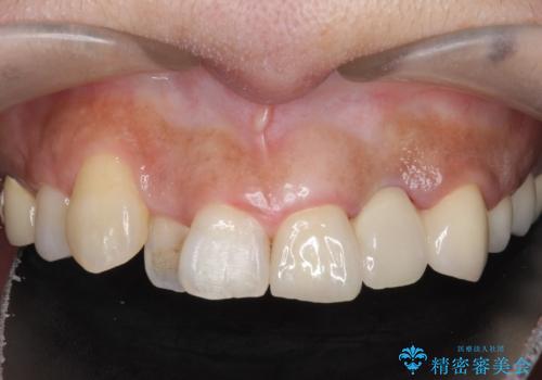 オールセラミッククラウン 根管治療のやり直しの治療後