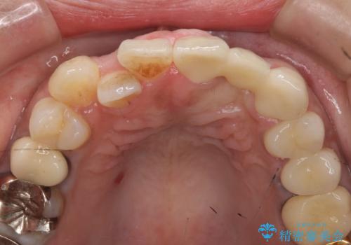 オールセラミッククラウン 根管治療のやり直しの治療後