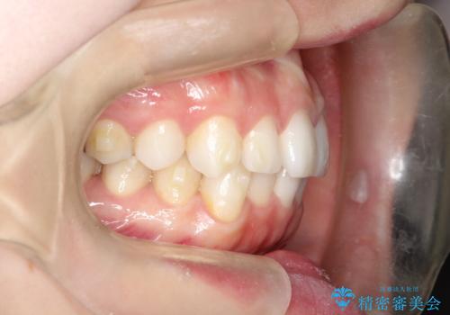 前歯のがたつきをインビザラインで目立たず矯正治療の治療中
