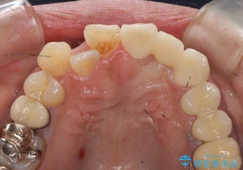 オールセラミッククラウン 根管治療のやり直しの治療後