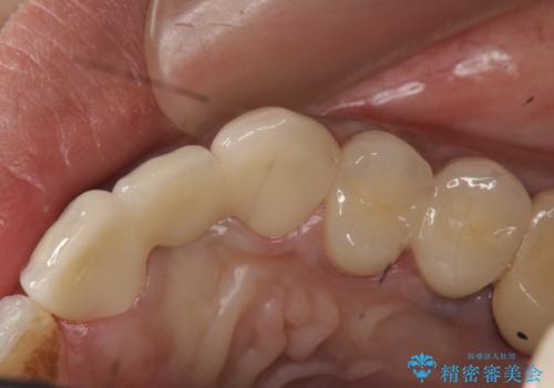 オールセラミッククラウン 根管治療のやり直しの治療後