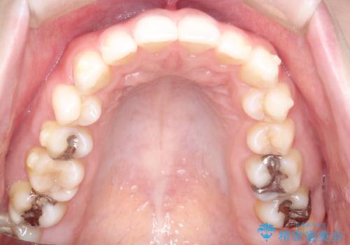 前歯のがたつきをインビザラインで目立たず矯正治療の治療中
