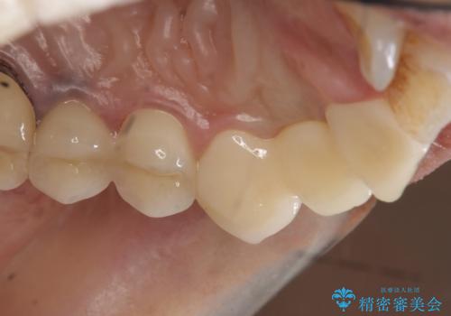 オールセラミッククラウン 根管治療のやり直しの治療後