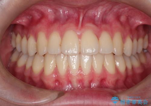 インビザラインによる非抜歯矯正 ガタガタな歯並びを整った歯並びへの症例 治療後