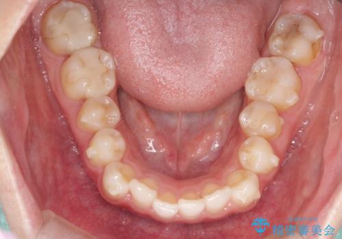 前歯のがたつきをインビザラインで目立たず矯正治療の治療中