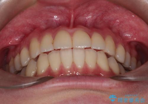 インビザラインによる非抜歯矯正 ガタガタな歯並びを整った歯並びへの治療後