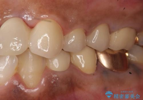 オールセラミッククラウン 根管治療のやり直しの治療後