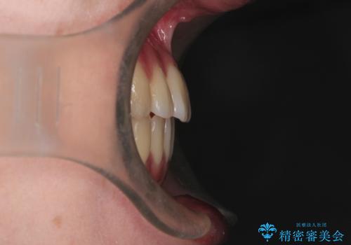 インビザラインによる非抜歯矯正 ガタガタな歯並びを整った歯並びへの治療後