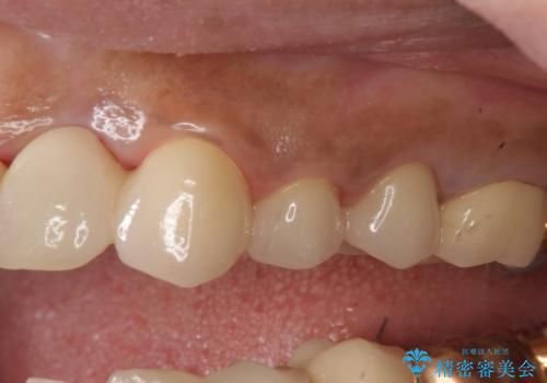 オールセラミッククラウン 根管治療のやり直しの治療後