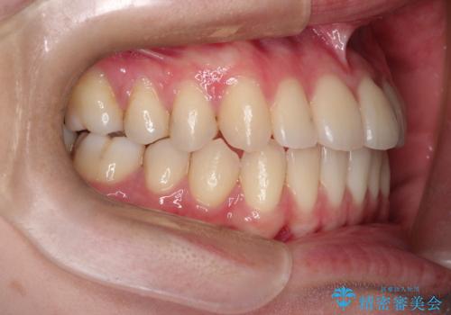 インビザラインによる非抜歯矯正 ガタガタな歯並びを整った歯並びへの治療後