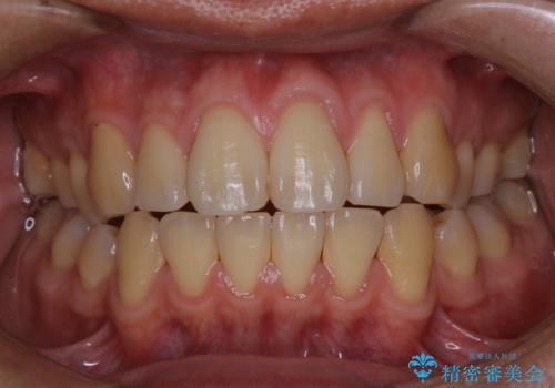 歯周病は細菌による感染症 その予防をPMTCでの治療前