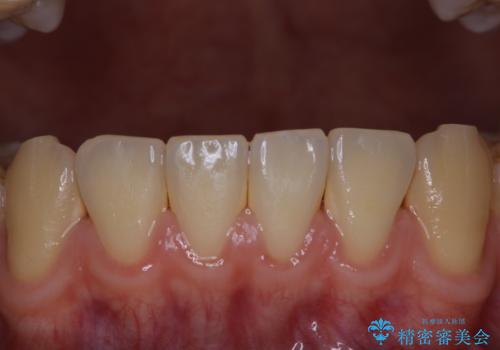 歯周病は細菌による感染症　その予防をPMTCでの症例 治療前