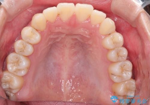 インビザラインによる非抜歯矯正　ガタガタな歯並びを整った歯並びへの治療後