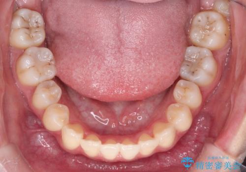 インビザラインによる非抜歯矯正 ガタガタな歯並びを整った歯並びへの治療後