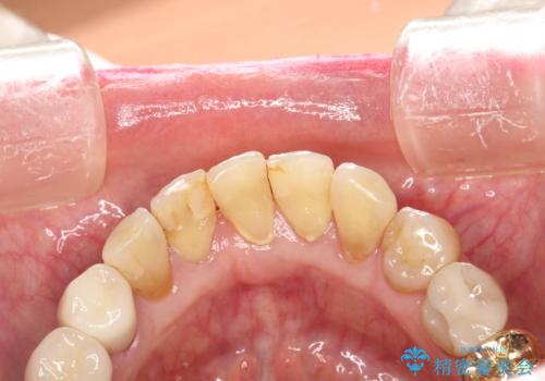 セラミックを入れた後もPMTCで定期的にメンテナンスの治療前