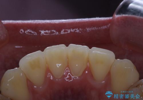 歯周病は細菌による感染症　その予防をPMTCでの治療前
