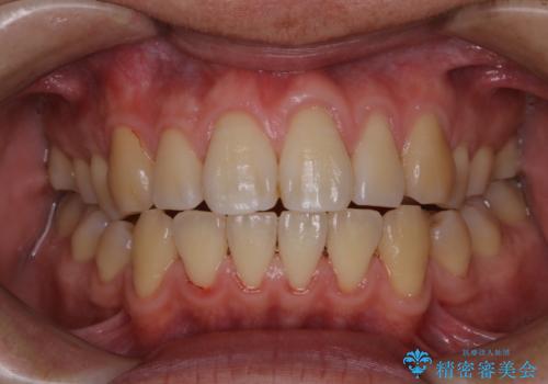 歯周病は細菌による感染症　その予防をPMTCでの治療後