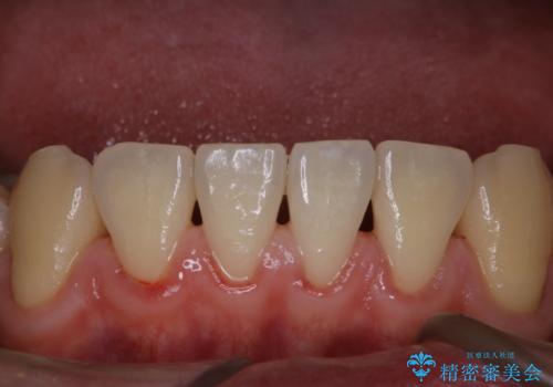 歯周病は細菌による感染症 その予防をPMTCでの症例 治療後