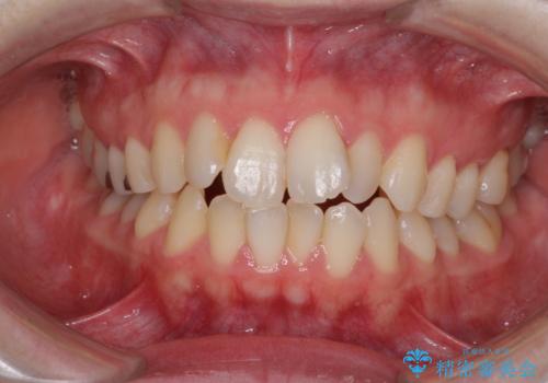 前歯のデコボコを改善　目立たないワイヤー矯正の症例 治療前