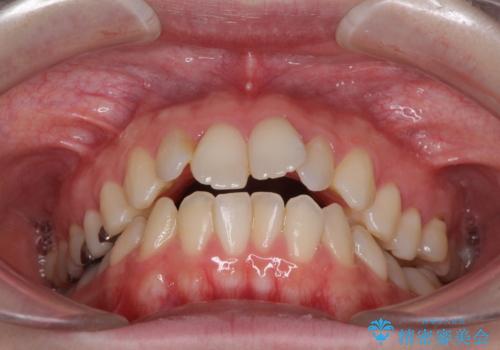 前歯のデコボコを改善 目立たないワイヤー矯正の治療前