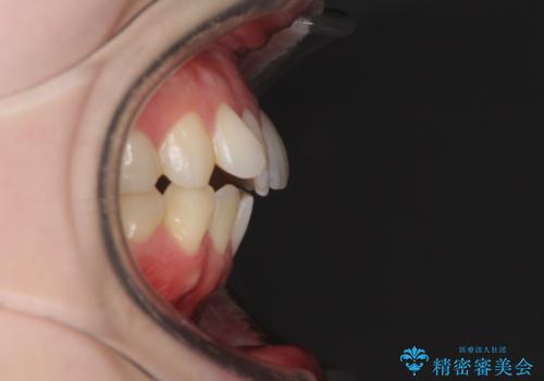 前歯のデコボコを改善 目立たないワイヤー矯正の治療前