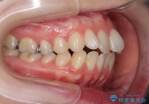 前歯のデコボコを改善 目立たないワイヤー矯正の治療前