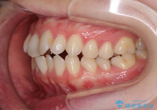 前歯のデコボコを改善 目立たないワイヤー矯正の治療前