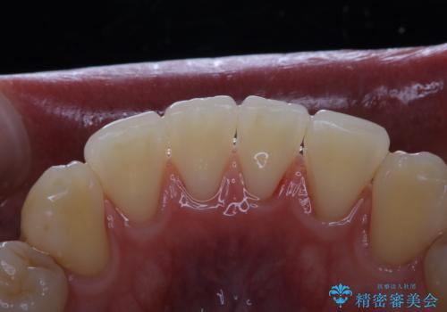 歯周病は細菌による感染症　その予防をPMTCでの治療後