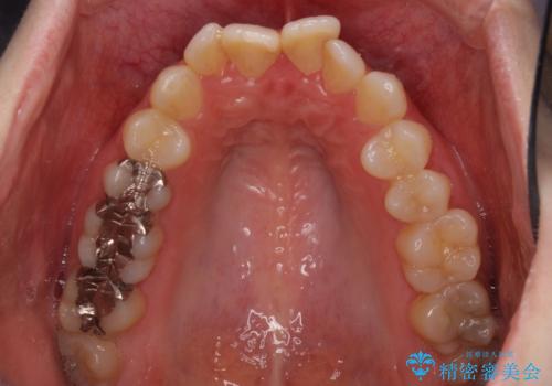 前歯のデコボコを改善　目立たないワイヤー矯正の治療前