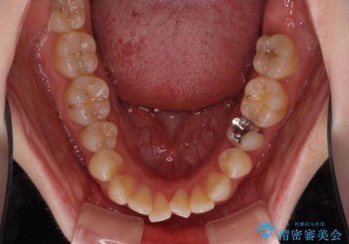 前歯のデコボコを改善 目立たないワイヤー矯正の治療前