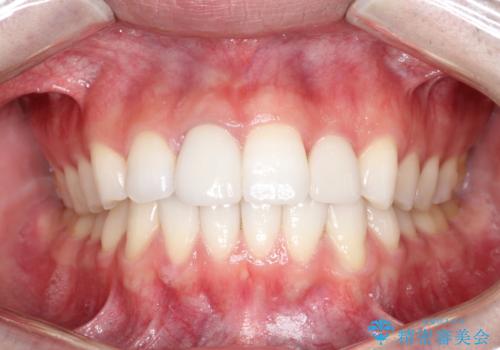 インビザラインとセラミック治療で整った歯並びへの症例 治療後