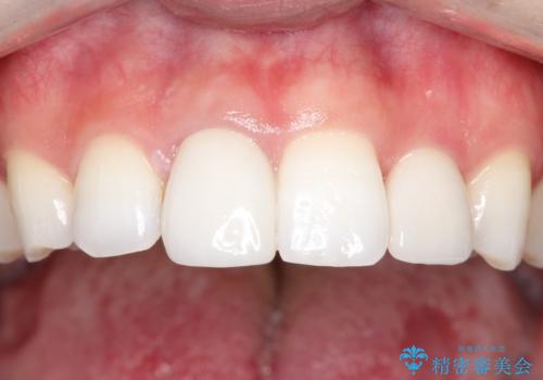 インビザラインとセラミック治療で整った歯並びへの治療後