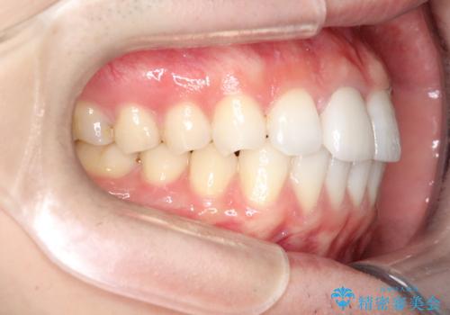 インビザラインとセラミック治療で整った歯並びへの治療後