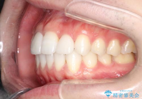 インビザラインとセラミック治療で整った歯並びへの治療後