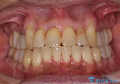 歯列不正と歯周病 総合歯科治療による全顎治療の治療中