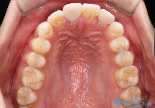 インビザラインとセラミック治療で整った歯並びへの治療後