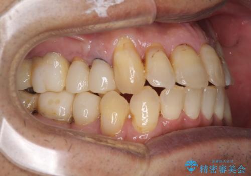 歯列不正と歯周病 総合歯科治療による全顎治療の治療中