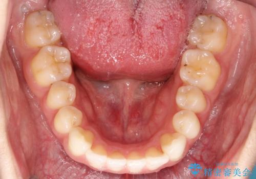 インビザラインとセラミック治療で整った歯並びへの治療後