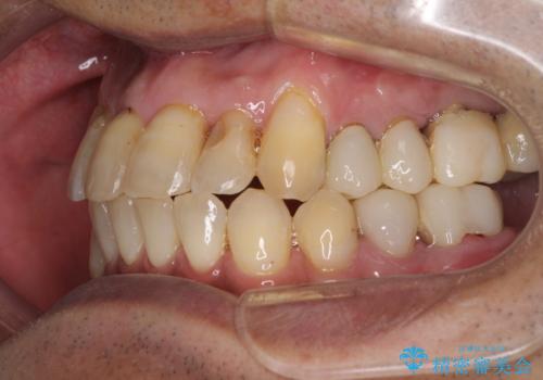 歯列不正と歯周病 総合歯科治療による全顎治療の治療中