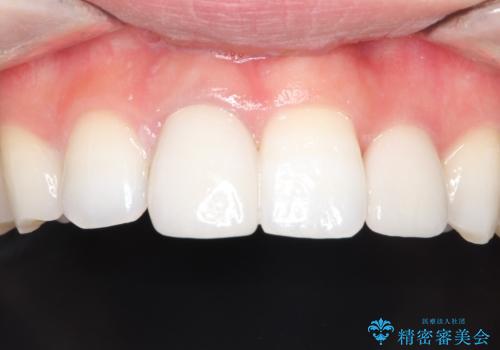 インビザラインとセラミック治療で整った歯並びへの治療後